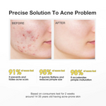 Salicylic Acid Precision Acne Spot Serum - Mink Muse