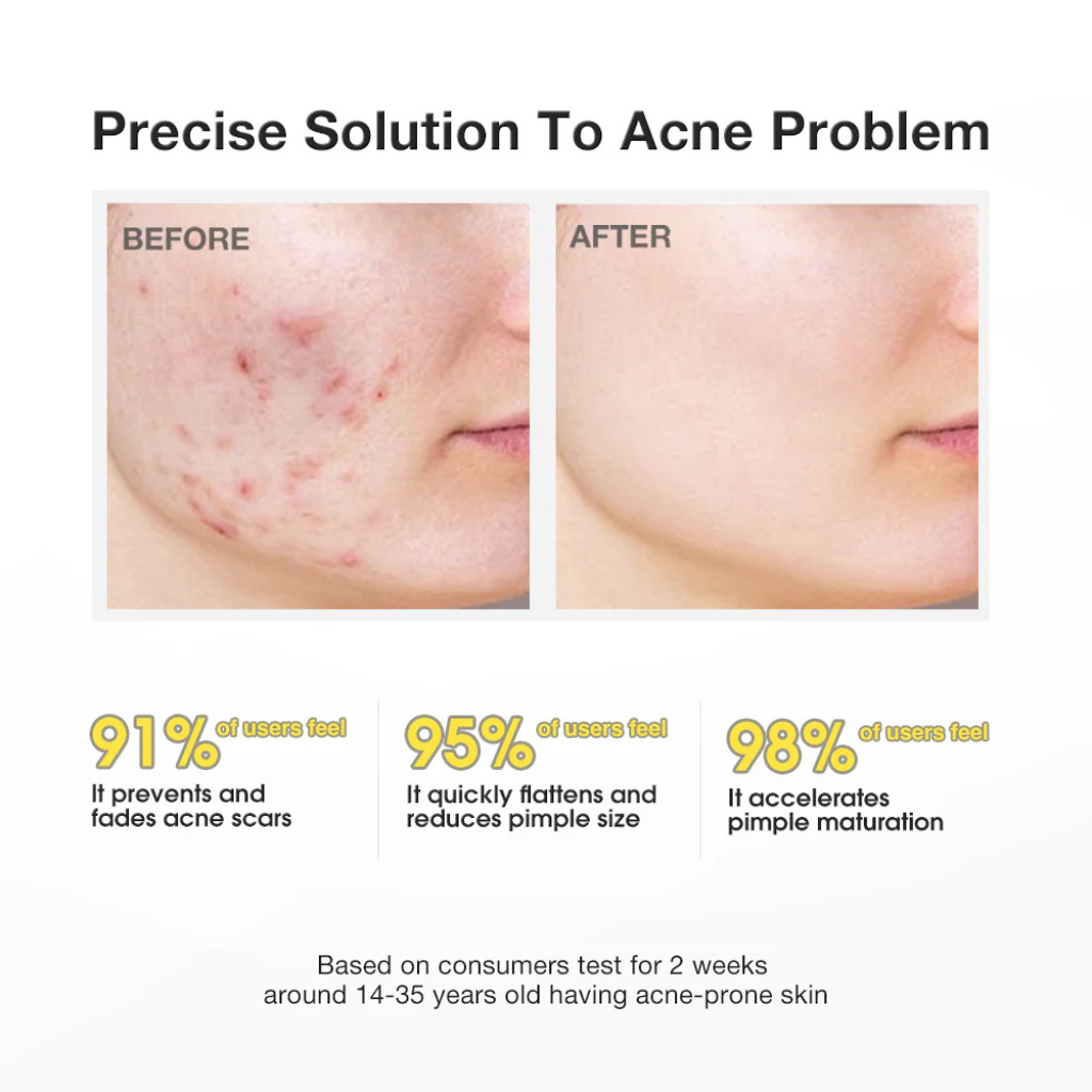 Salicylic Acid Precision Acne Spot Serum - Mink Muse